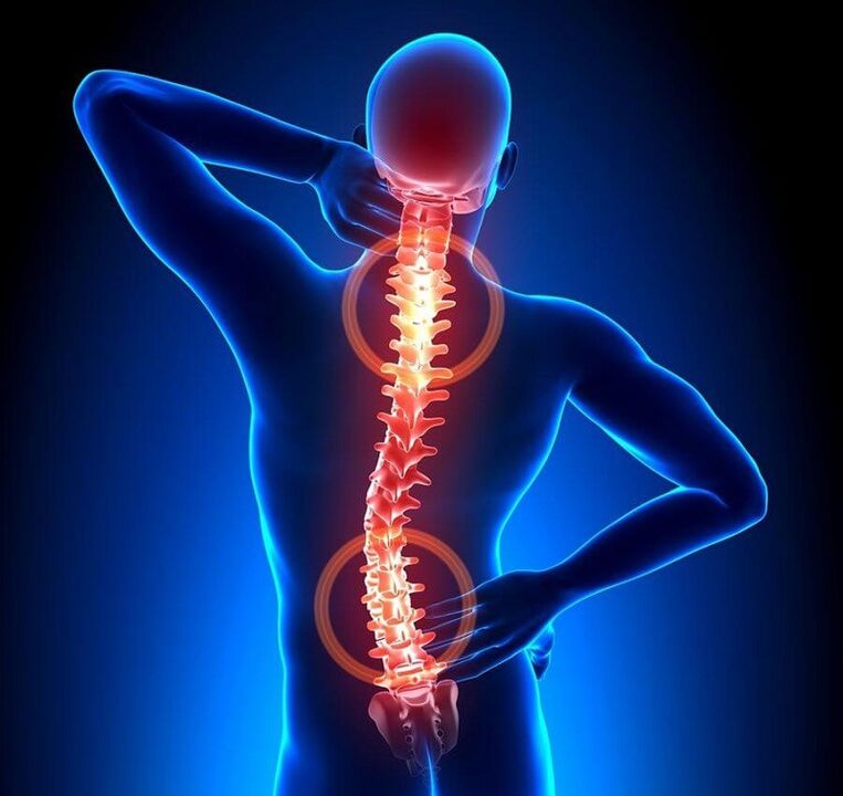 Osteoarthritis of the spine is the cause of back pain