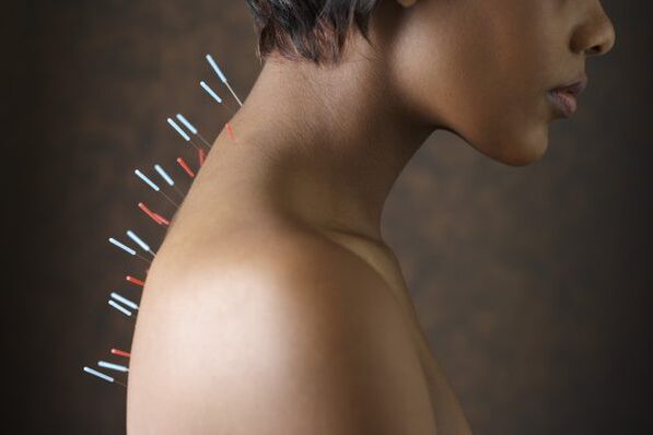 Acupuncture for back pain