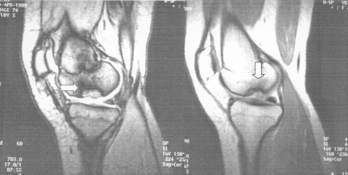 X-ray discriminating osteonecrosis in the knee joint