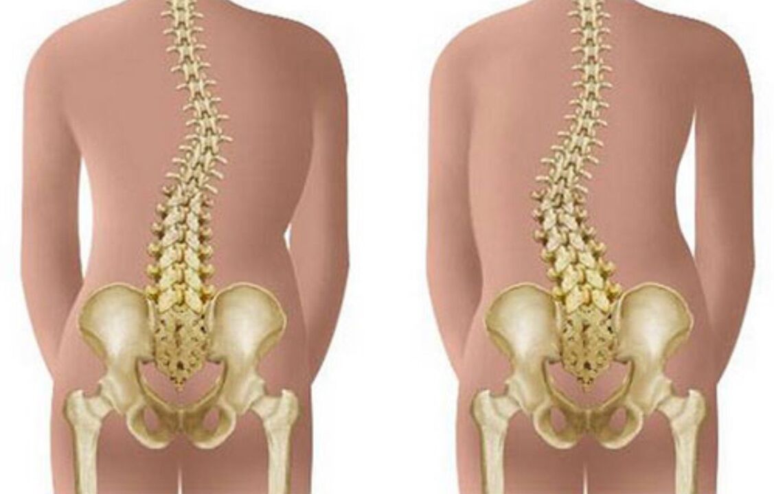 Scoliosis is the cause of back pain in the shoulder area