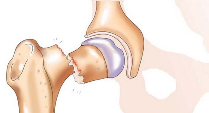 Femoral neck fracture is accompanied by severe pain in the hip joint