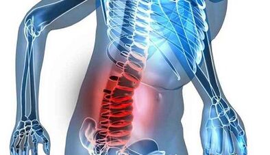 Signs and symptoms of lumbar osteoarthritis