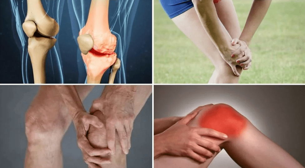Symptoms of arthritis