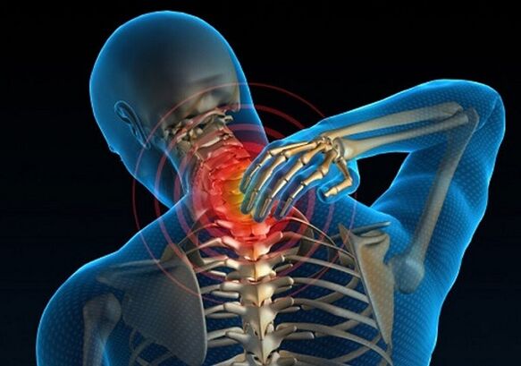 neck pain due to osteoarthritis