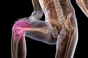 Joint pain due to knee arthritis