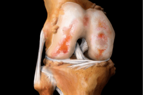 Knee joint damage due to arthritis