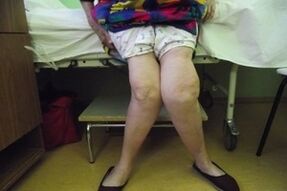 Progressive arthritis of the knee joint