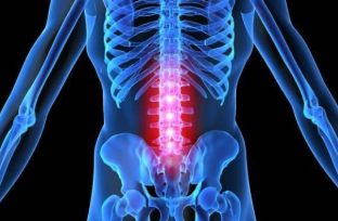 Vertebral osteochondrosis