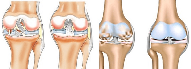 Arthritis and joints