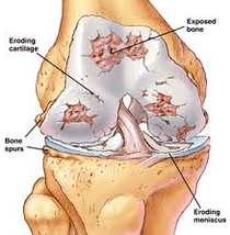 Mechanism of development of arthritis